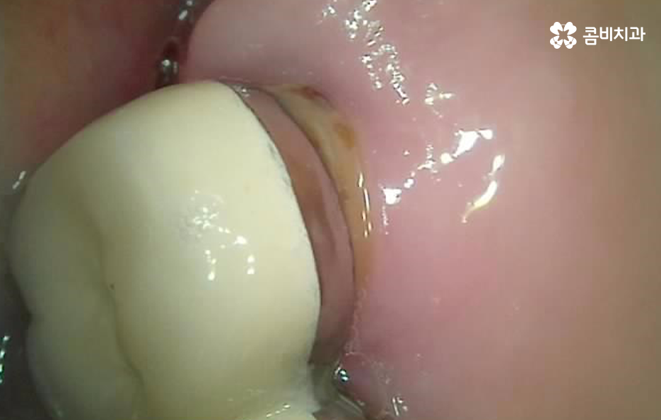 명동치과 놓치기 쉬운 2차충치에 주의하려면 관련 이미지 4