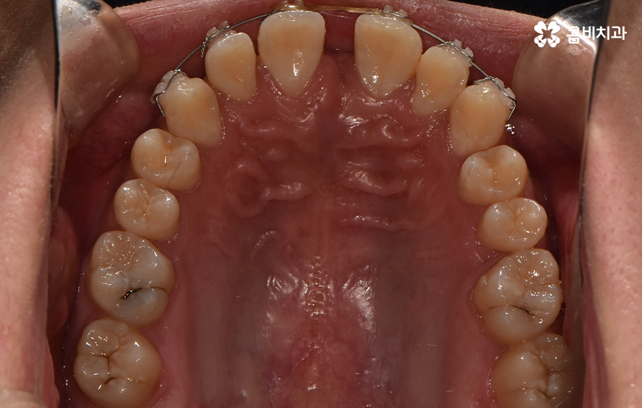 앞니만 교정 과잉치 뽑아서 해결했어요 관련 이미지 10