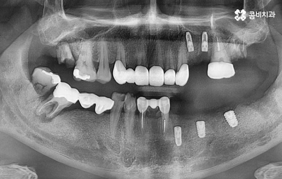임플란트 치조골 상태에 따라 치료 계획도 달라지나요 관련 이미지 6