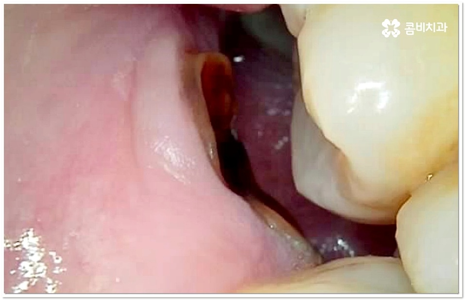 어금니 충치치료 빠를수록 좋아요 관련 이미지 9