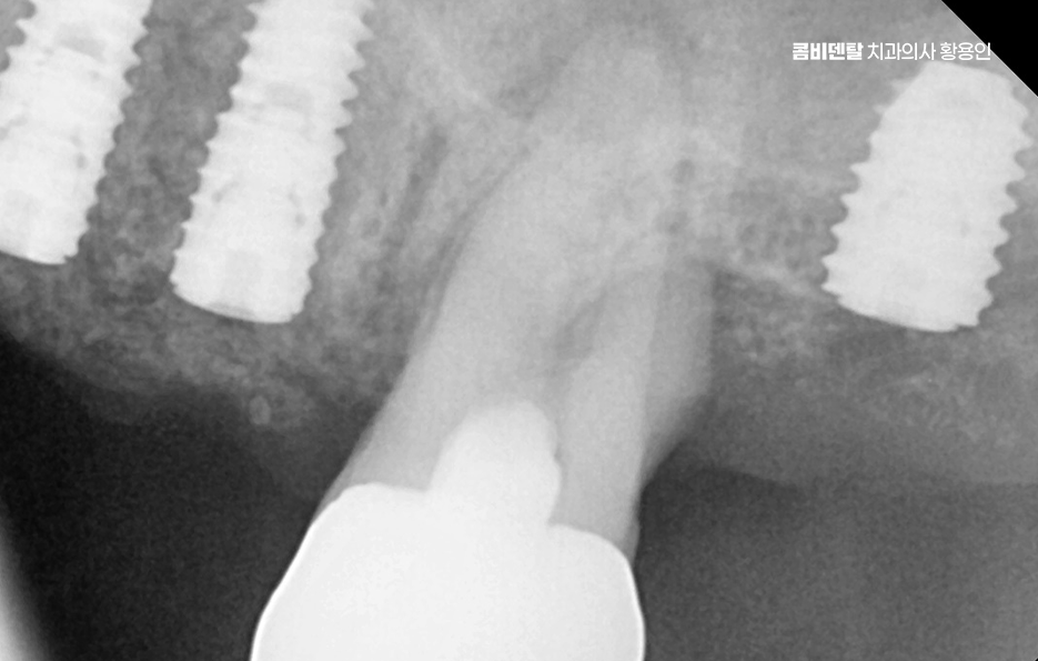 치아 발치 후 임플란트 언제부터 준비할까 관련 이미지 6