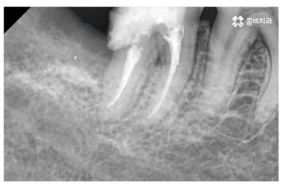 누운 사랑니 발치와 어금니신경치료를 하게 된 사례 관련 이미지 7