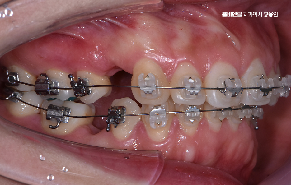 돌출입 팔자주름 교정 얼마나 바뀔까요 관련 이미지 7
