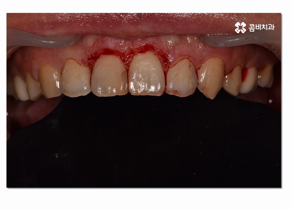 치주질환 치료의 중요성과 치은절제술이 활용된 사례 관련 이미지 5