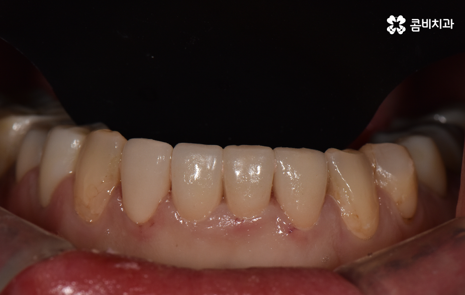 아래 앞니깨짐 치료 감쪽같이 해결하려면 관련 이미지 11