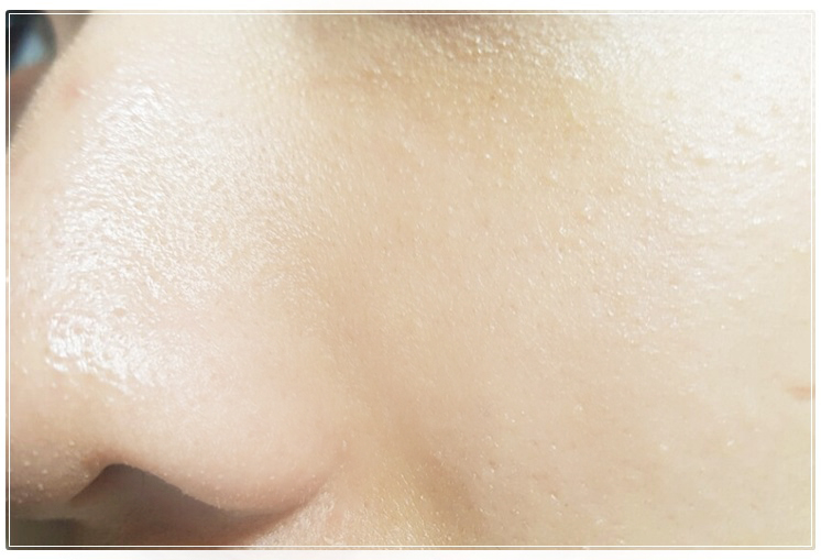 블랙헤드없애는법 더 강력하게 돌아왔다 관련 이미지 10