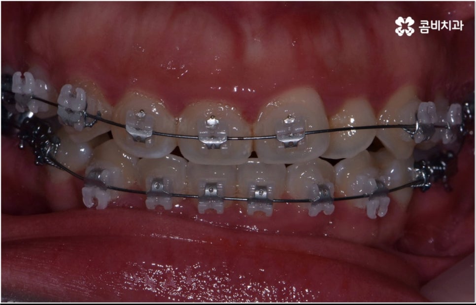 성인 치아교정 기간 걱정이 앞서나요 관련 이미지 7