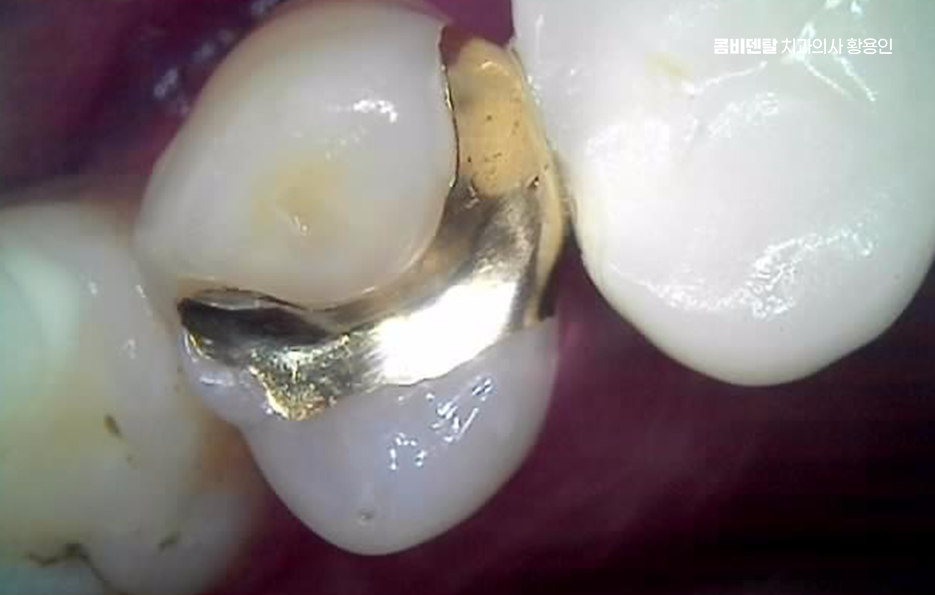 오래된 보철물 아말감 교체 어떠한 케이스일까 관련 이미지 5