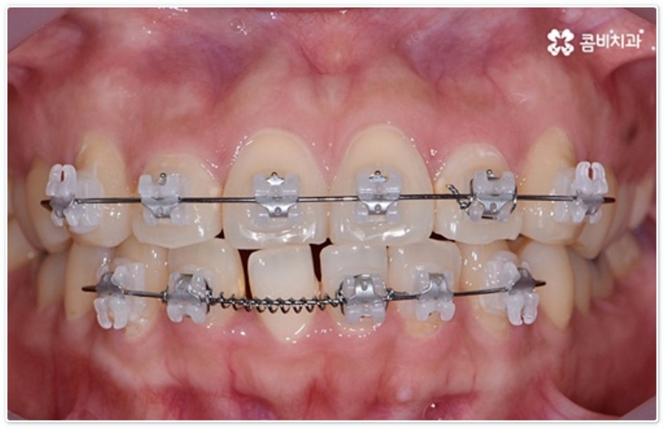 앞니부분교정 누구나 할수있나요? 관련 이미지 9