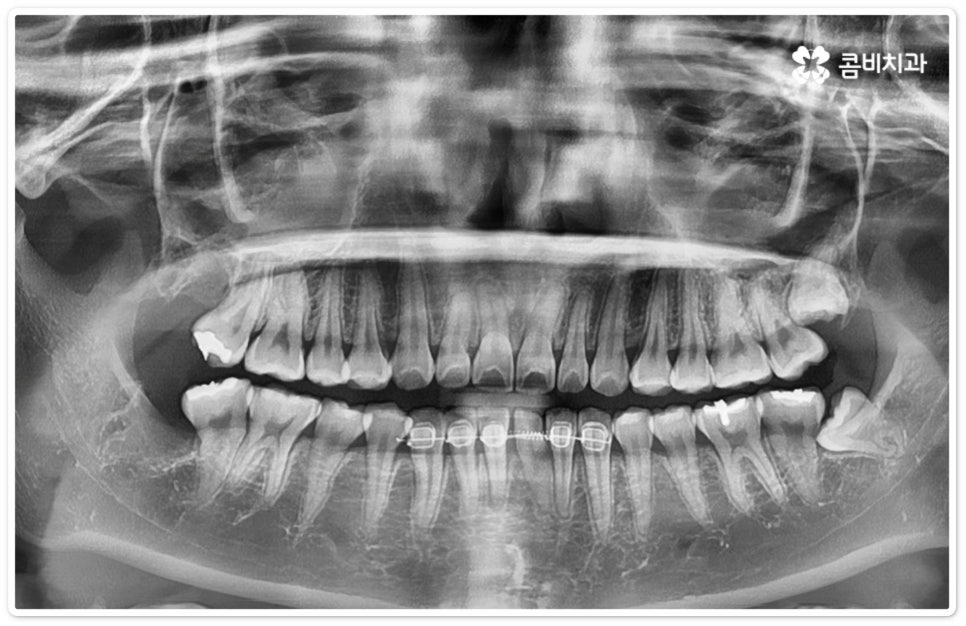 누운사랑니발치 이모저모 알아봐요 관련 이미지 10