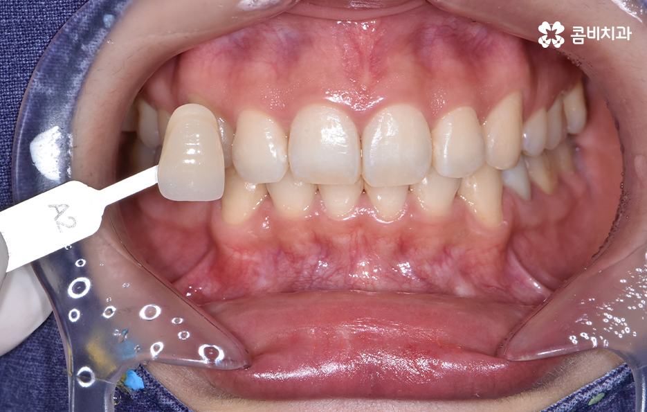 치과 치아미백 이렇게 시작해보세요 관련 이미지 1