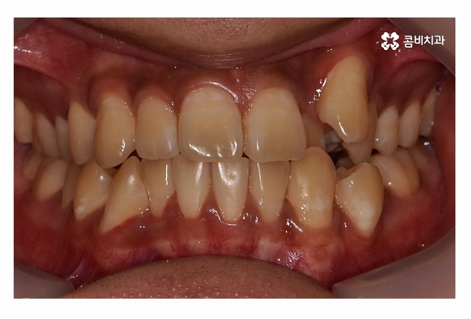 덧니 발치 필수적으로 하는건가요 관련 이미지 1