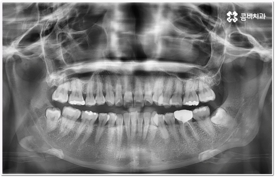 돌출입교정치과 알아보는 기준은 관련 이미지 2