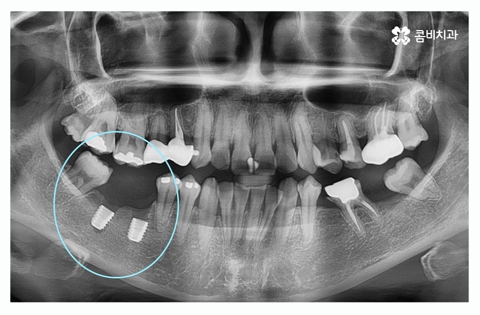 임플란트종류 잘알아보고 적용하려면 관련 이미지 2