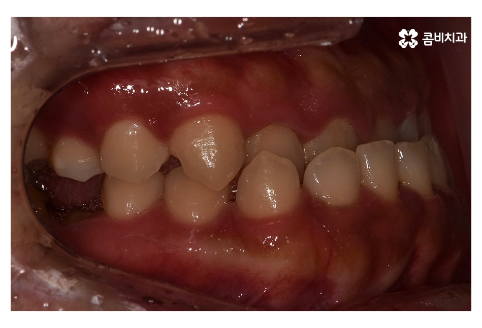 클리피씨교정 늦지않게 결정하려면 관련 이미지 2