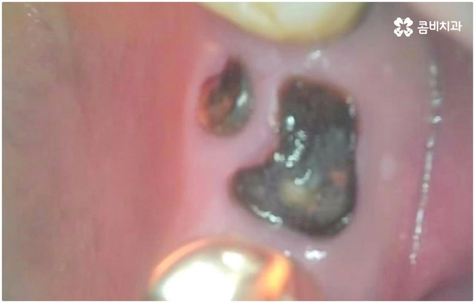 발치후 임플란트 바로 되나요? 관련 이미지 4