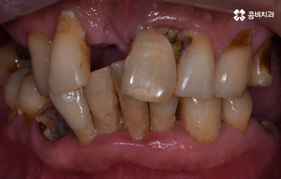 치주염 발치 이렇게나 심각하네요 관련 이미지 5