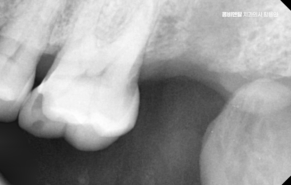 어금니 없으면 얼굴 발음에 어느정도나 안좋을까 관련 이미지 6