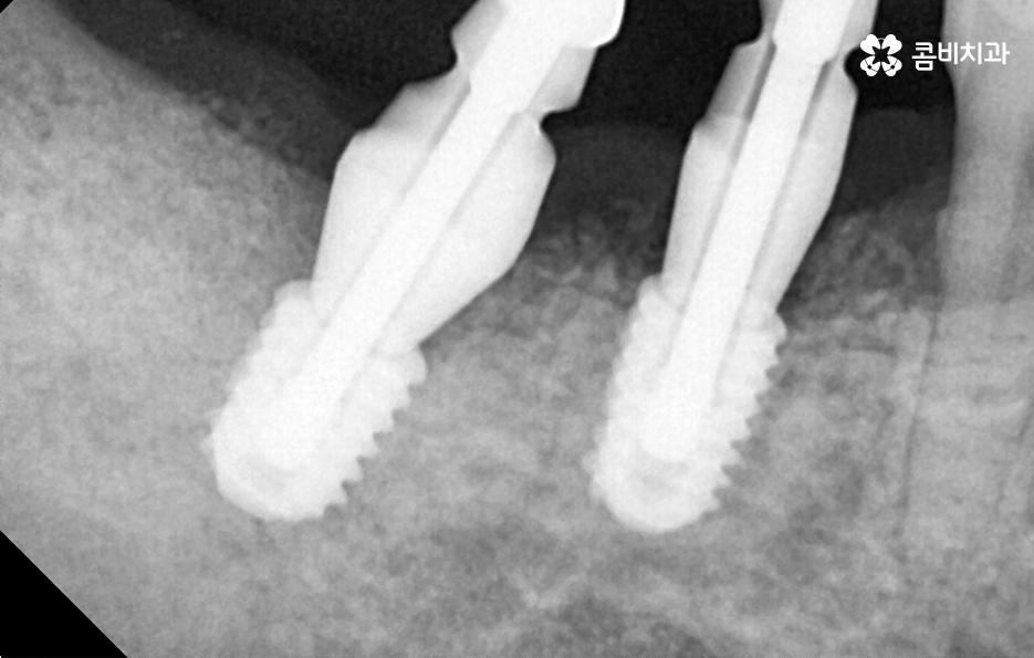 건강보험 임플란트 적용 받기 전에 알아두세요 관련 이미지 7