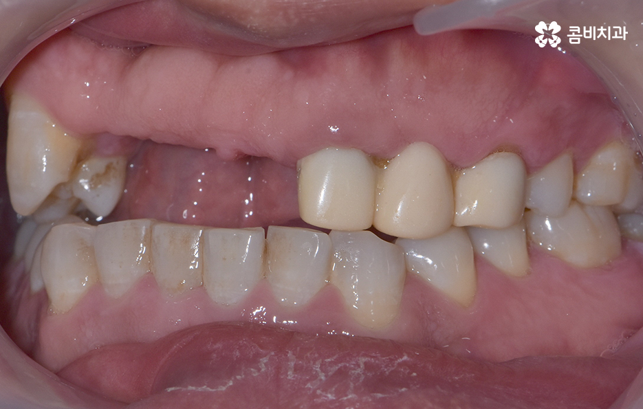 앞이빨 임플란트 과정 주의해야할 포인트는 관련 이미지 4