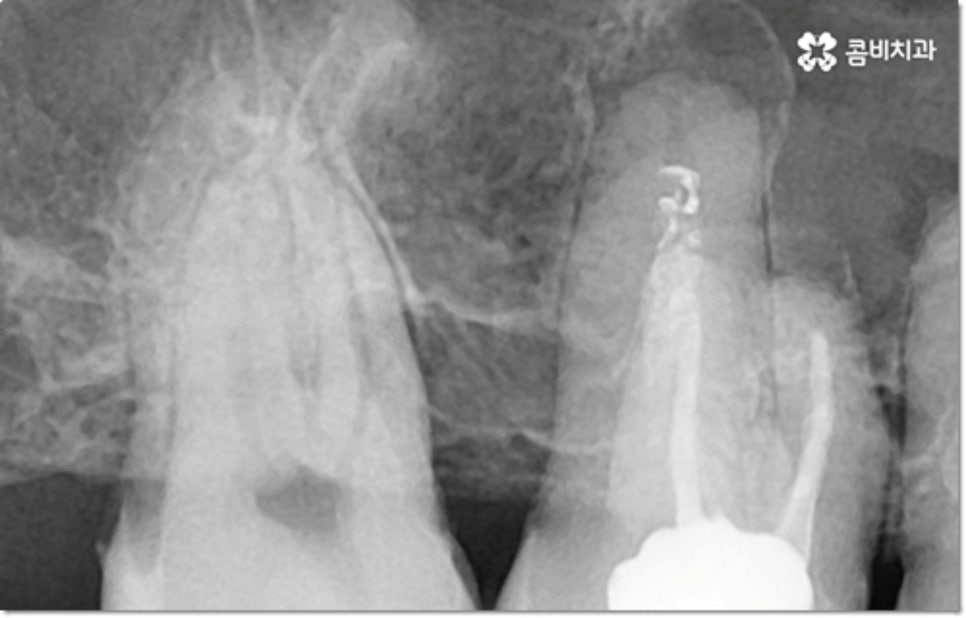 아랫니임플란트 주의할것들은? 관련 이미지 9