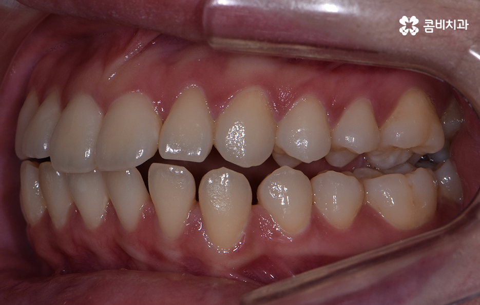 아래앞니 벌어짐 교정으로 해결했어요 관련 이미지 3