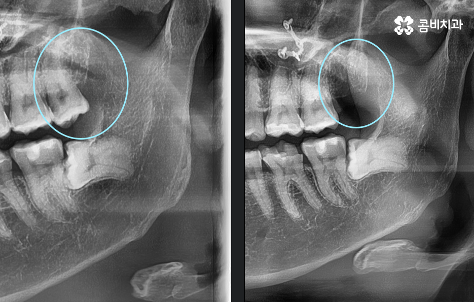사랑니 발치 시기 이럴때 시작하면 좋아요 관련 이미지 8