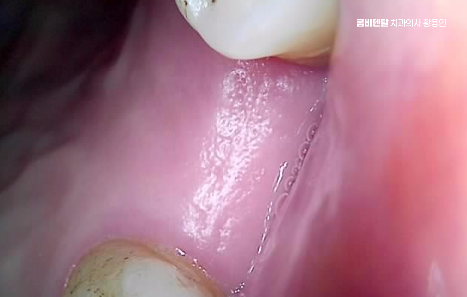 어금니 없으면 얼굴 발음에 어느정도나 안좋을까 관련 이미지 3