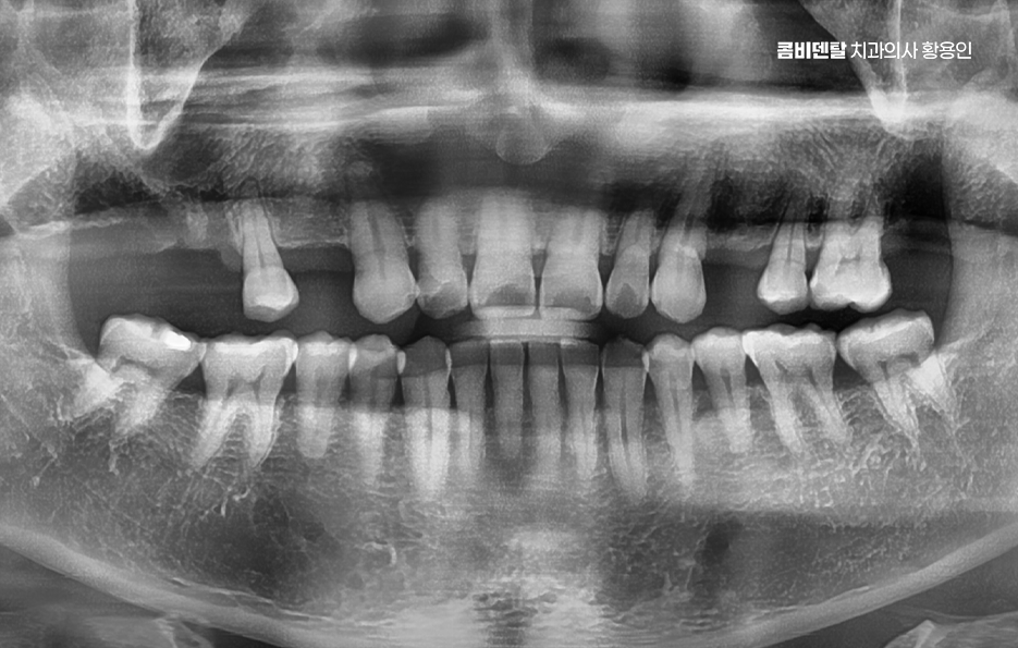 어금니 없으면 얼굴 발음에 어느정도나 안좋을까 관련 이미지 1