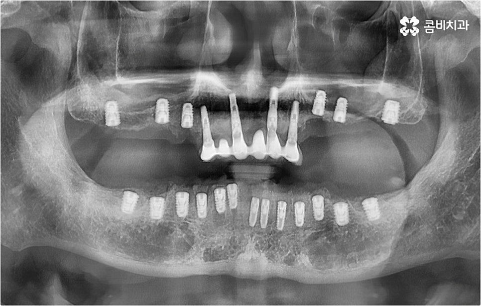 전악임플란트 고려할 사항들은 관련 이미지 14