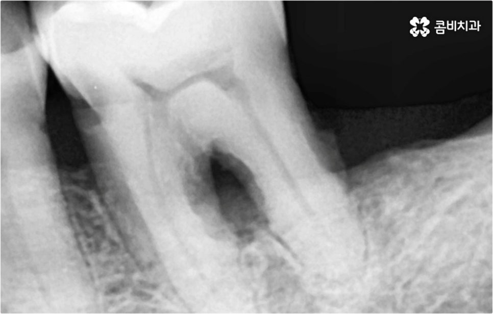 전악임플란트 고려할 사항들은 관련 이미지 8