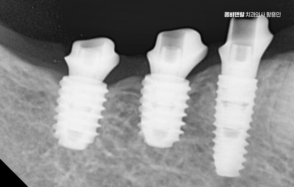 어금니 임플란트 안하면 후회하게 되는걸까 관련 이미지 10