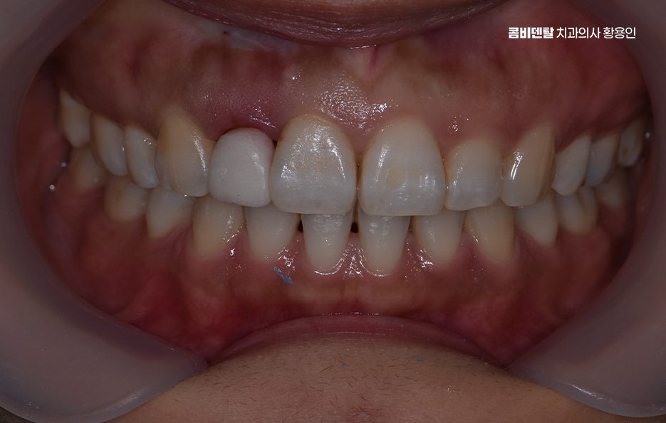 앞니 올세라믹 이건 알고 시작하세요 관련 이미지 6