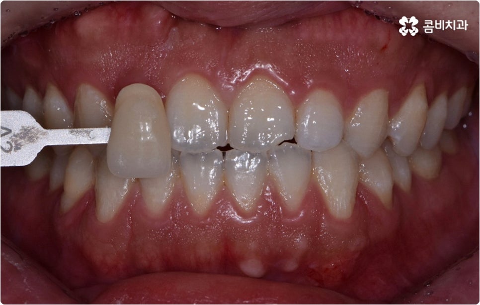 치아미백시술 관심있다면 관련 이미지 1