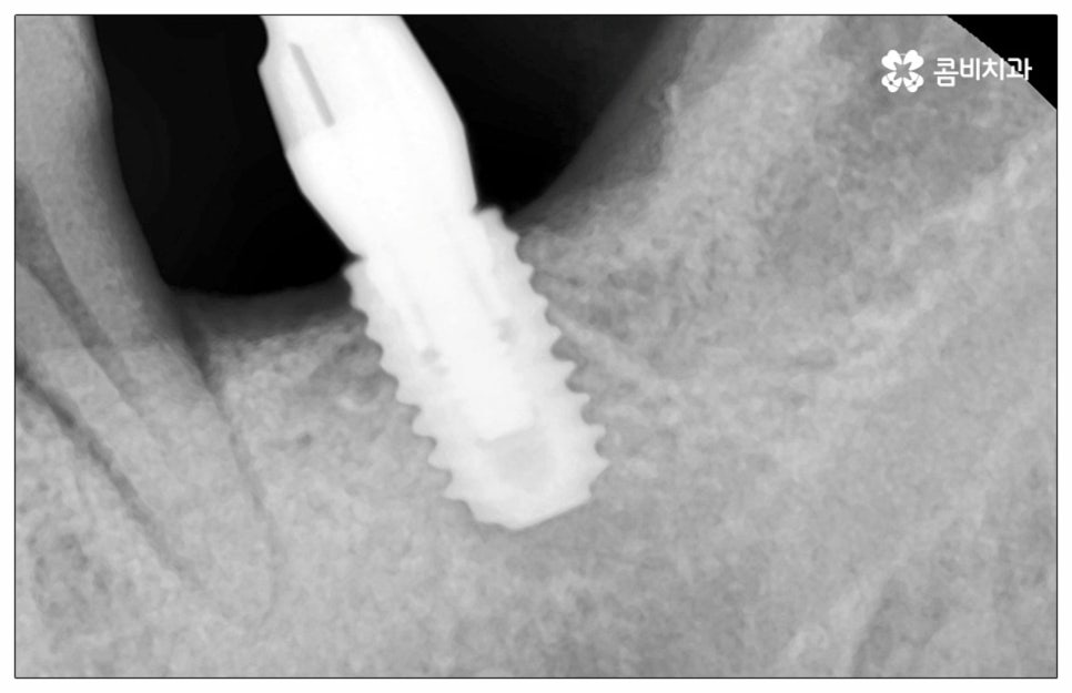 건강보험임플란트 혜택받아 보세요 관련 이미지 2