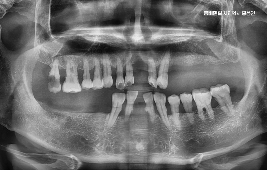 임플란트 뼈이식 안하면 어떤 문제가 있는거죠 관련 이미지 1