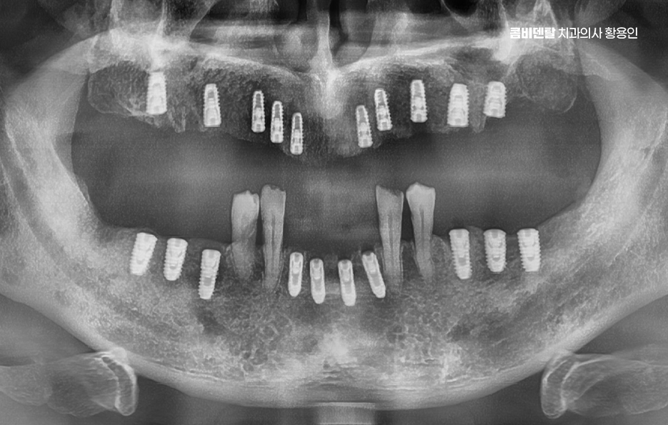 윗니 전체 임플란트 뭐부터 해야할까 관련 이미지 4