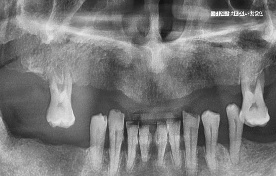 윗니 전체 임플란트 뭐부터 해야할까 관련 이미지 5