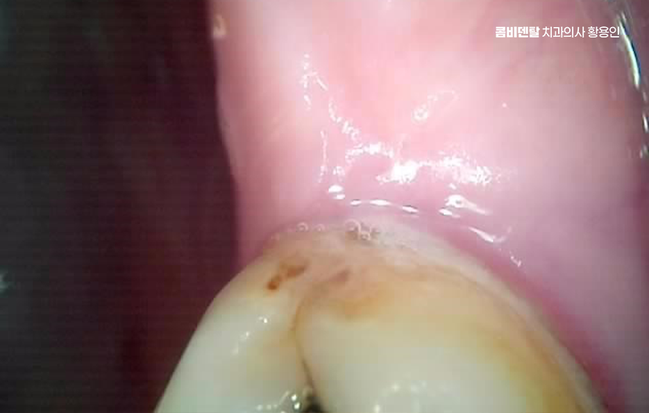 인레이 치료 후 신경치료 이유가 궁금하다면 관련 이미지 4