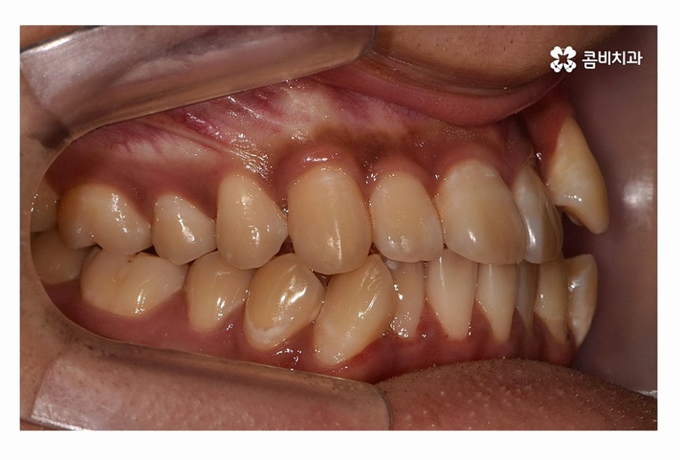 덧니 발치 필수적으로 하는건가요 관련 이미지 2