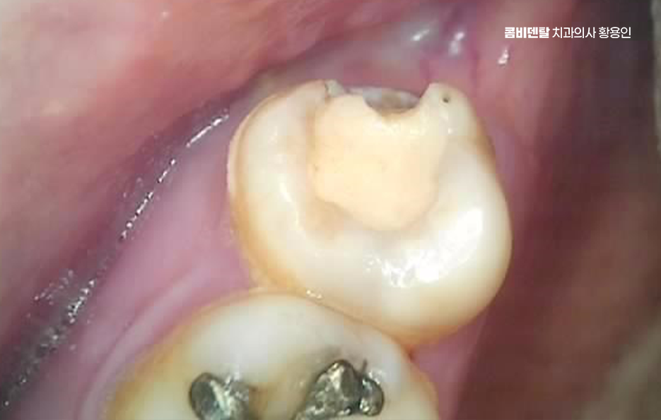 인레이 치료 후 신경치료 이유가 궁금하다면 관련 이미지 2