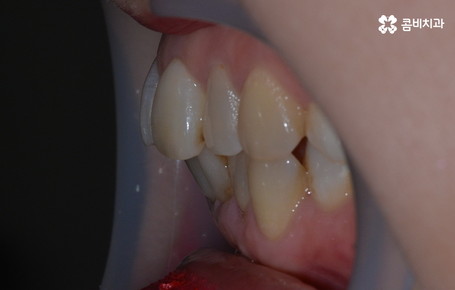 돌출입 콤비교정으로 얼굴까지 개선하는 방법은 관련 이미지 5