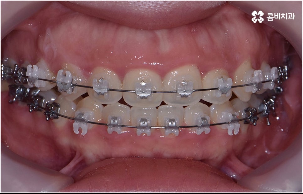 성인 치아교정 기간 걱정이 앞서나요 관련 이미지 8