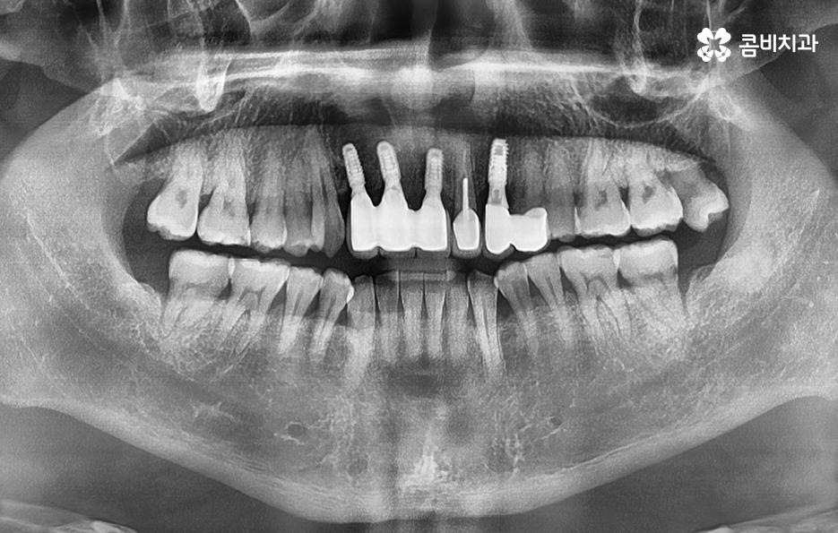 앞이빨 임플란트 과정 주의해야할 포인트는 관련 이미지 6
