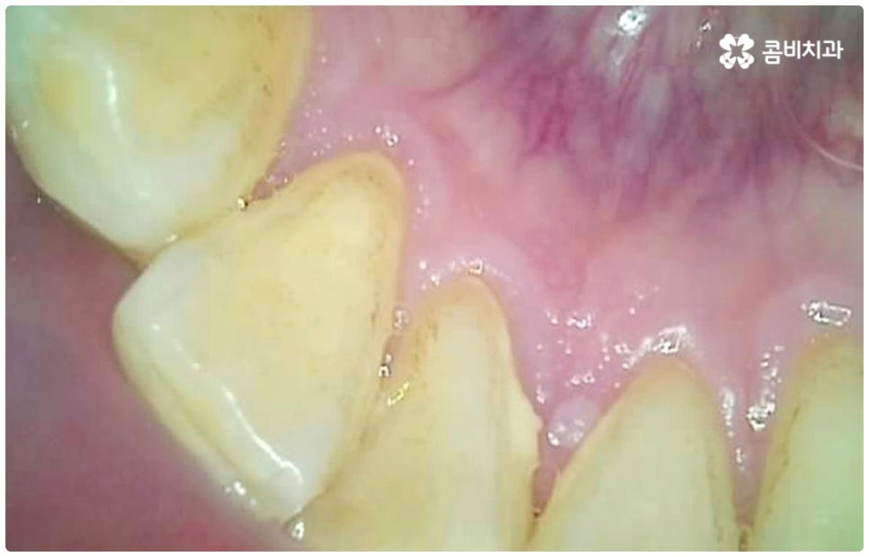 충치치료종류 알아볼까요? 관련 이미지 1