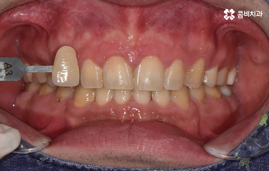 치과 치아미백 이렇게 시작해보세요 관련 이미지 6