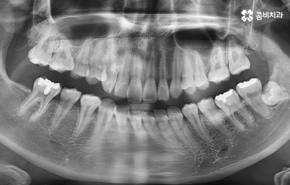 누워있는 사랑니 꼭 뽑아야 하는 경우는 언제일까 관련 이미지 1