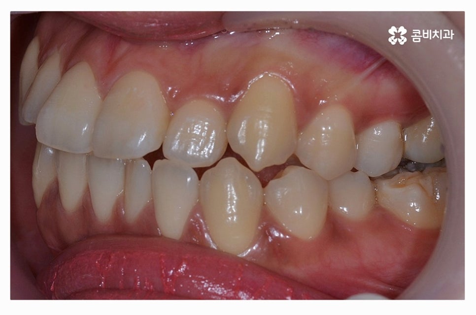 덧니교정 정교하게 따져보려면 관련 이미지 3