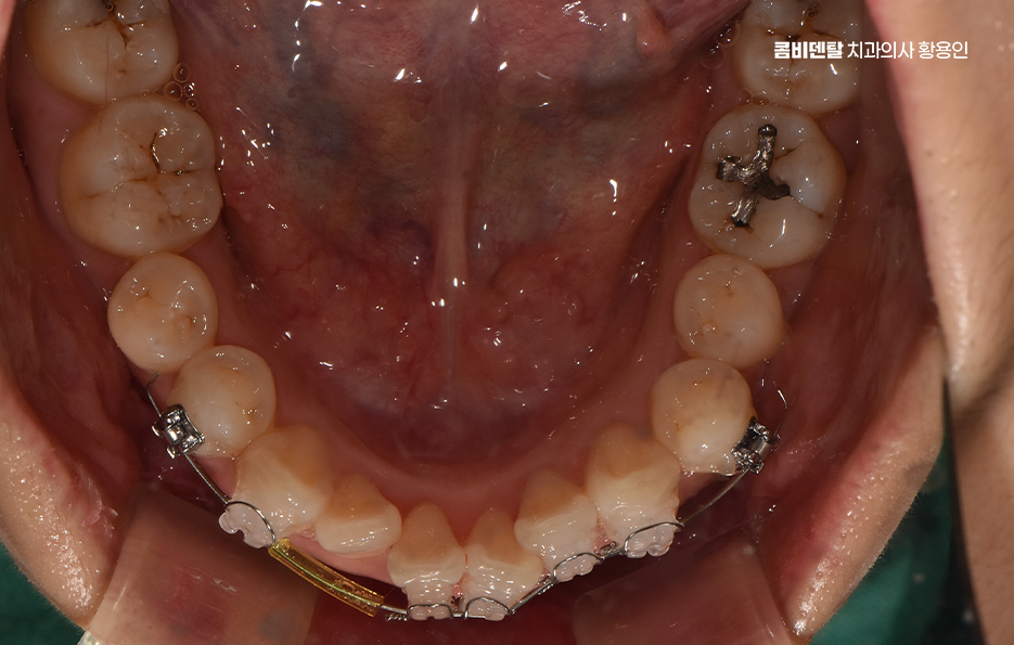 앞니 부분 교정 간단하니까 좋은건가요 관련 이미지 11