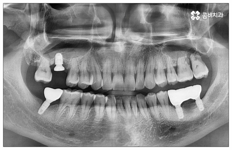 건강보험임플란트 혜택받아 보세요 관련 이미지 12